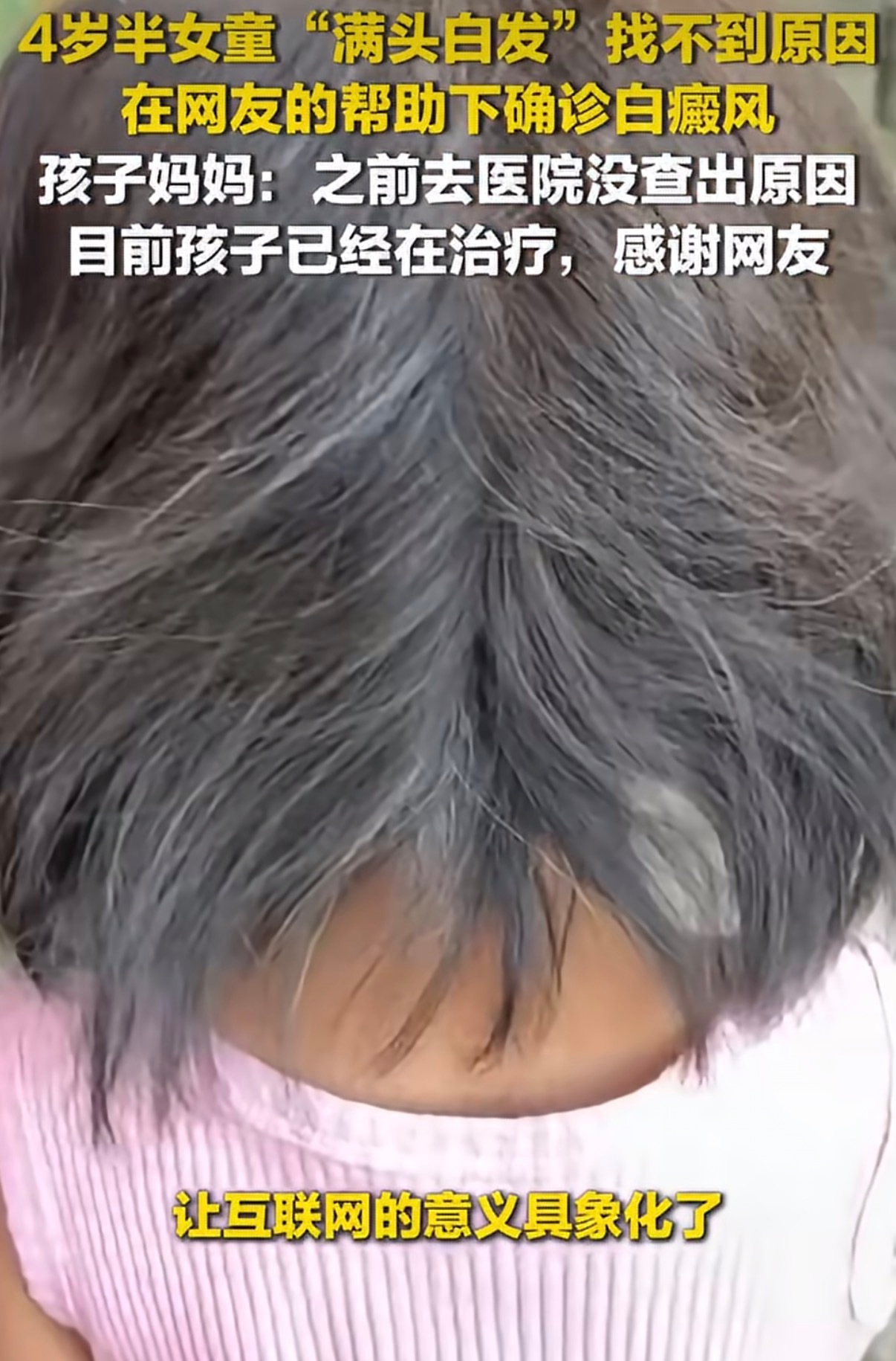 4岁半女童满头白发网友提醒白癜风 这件事我也是第一次知道，原来白癜风不一定只是皮