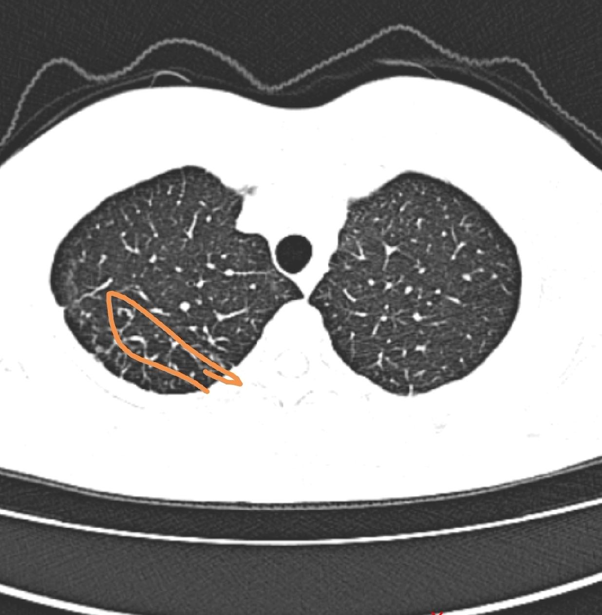 你早十年戒烟，肺也不至于此，医生你不要讲这个了，现在讲也没用。这是我在门诊上和一