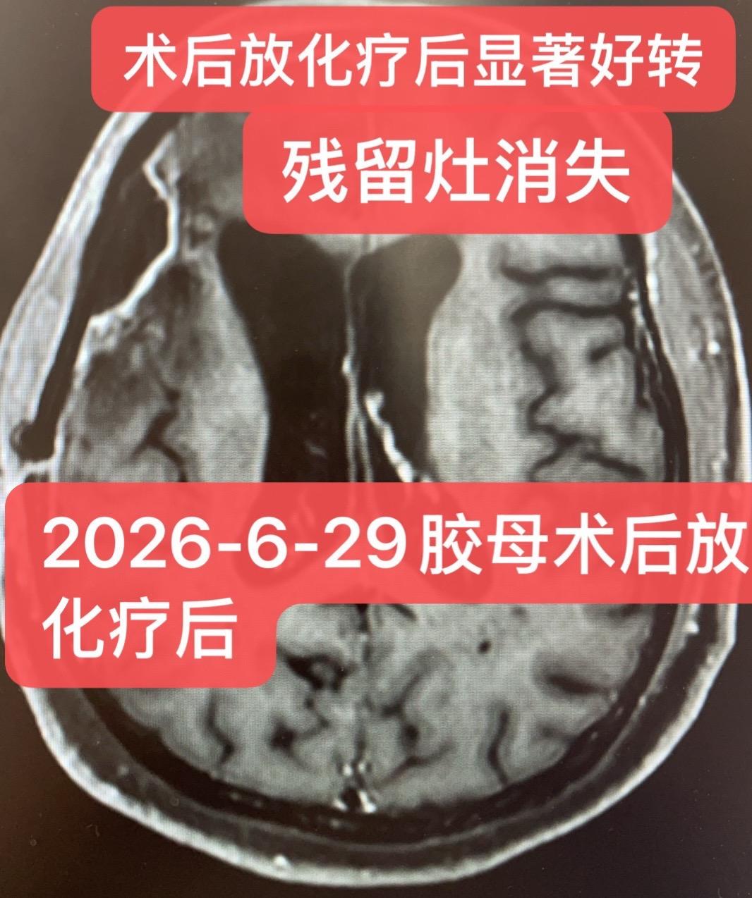 胶质母细胞瘤术后残留：放化疗巩固。胶质母细胞瘤术后残留的放化疗巩固治疗...