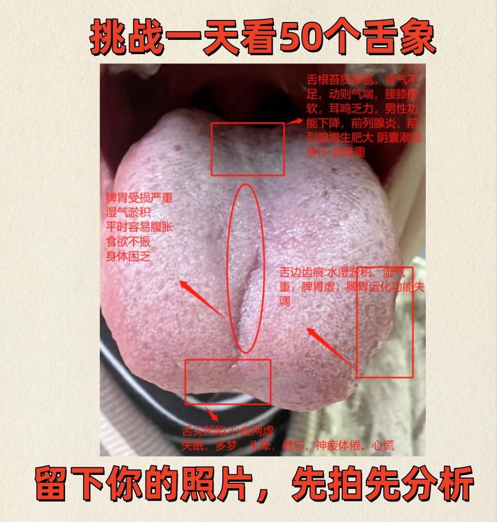 今日实战——分析50个舌象！！！

应粉丝的要求，坚持每天为大家分析舌象！

先
