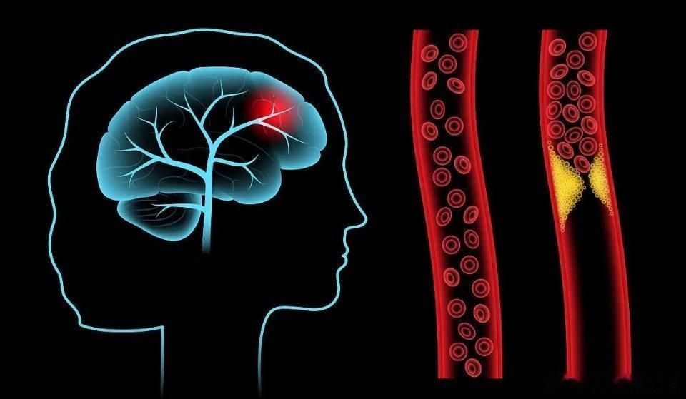 给脑梗患者的五条常见忠告：1、遵循医生的指导：首先，始终遵循医生的指导和治疗计划