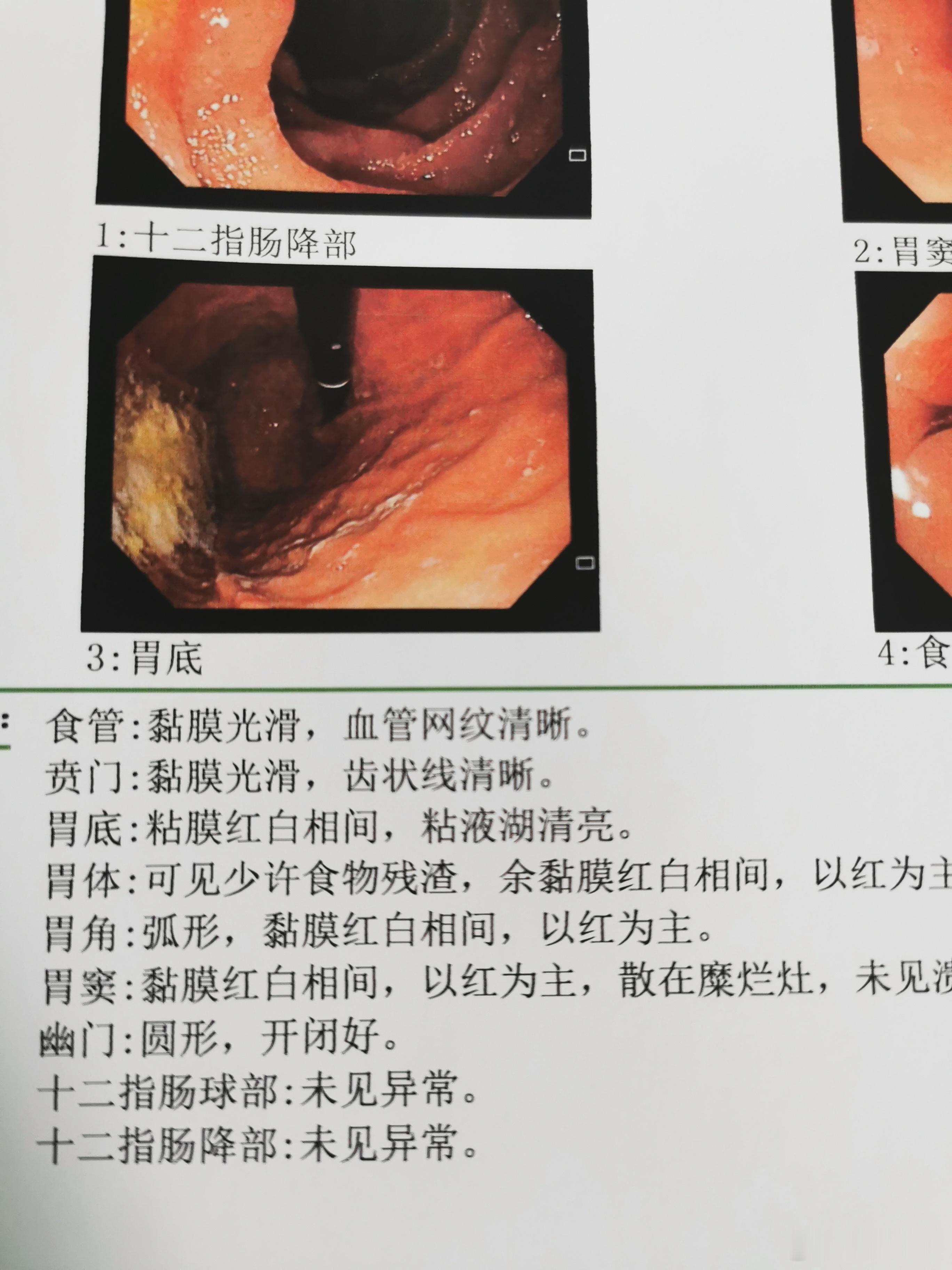 做胃镜检查需要空腹 6 至 8 小时以上。 空腹的目的是为了保证胃内没有食物残渣