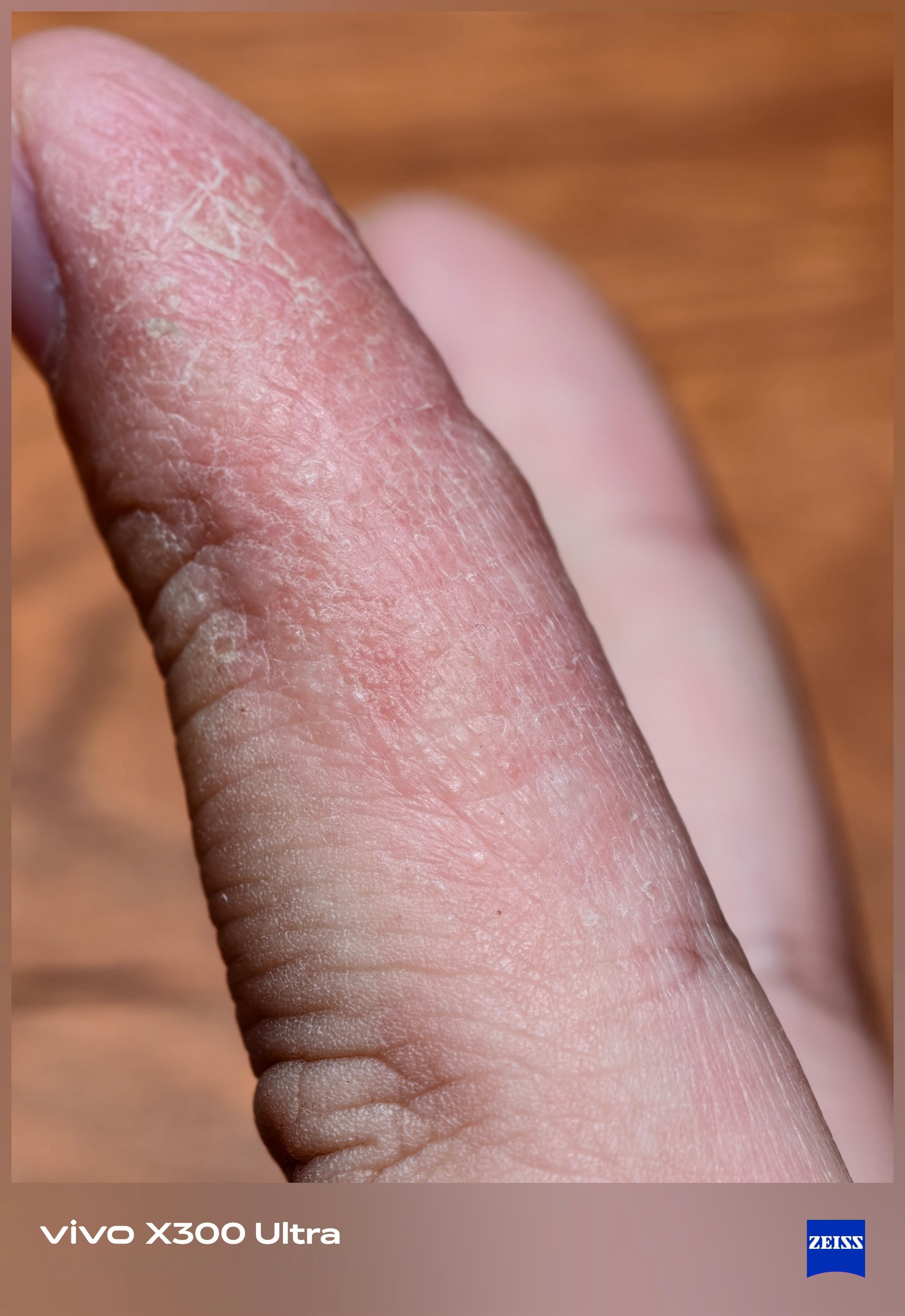 X300 Ultra 的微距也还是非常可以的…我手上的汗疱疹已经好几年了，每到换