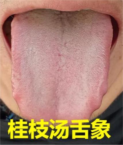 受寒发热，选麻黄汤还是桂枝汤？看舌象教你！
 
1. 舌苔薄白桂枝汤
这类患者外