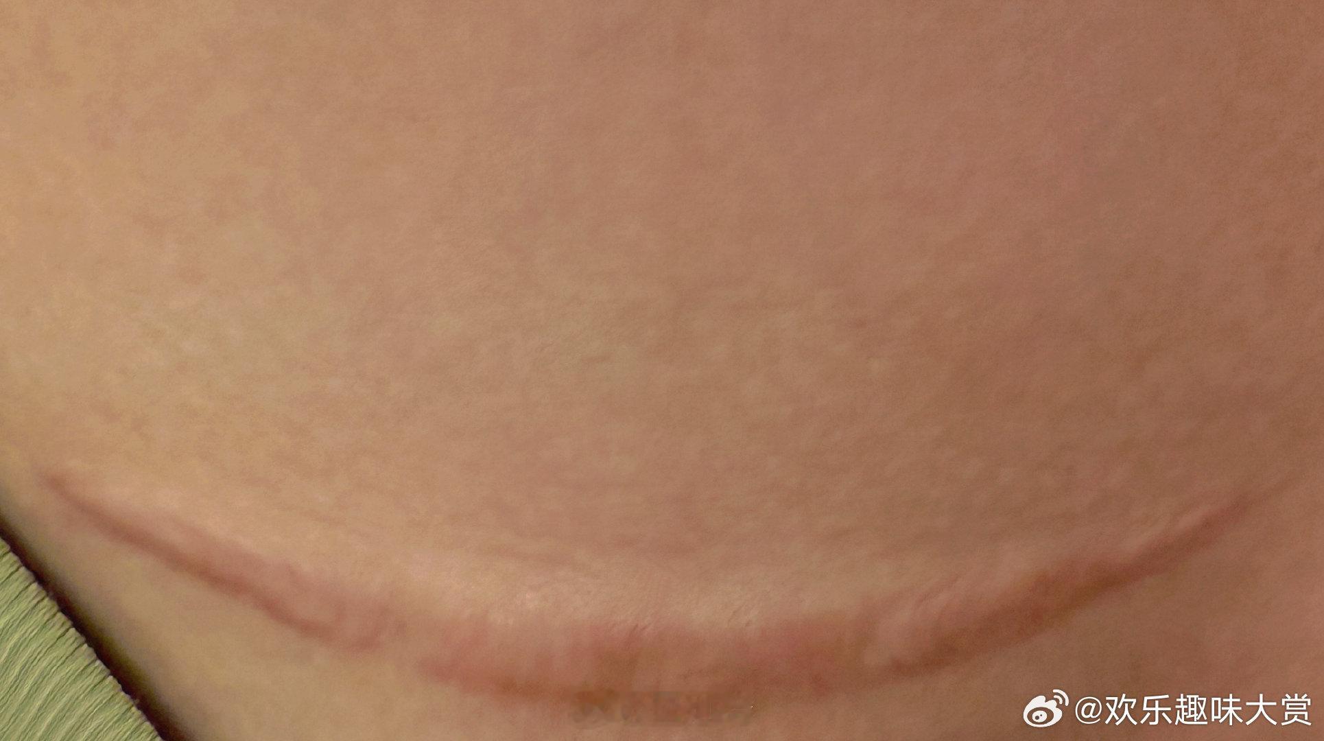 王灿我和我的疤痕和解了王灿和自己的疤痕和解了王灿和自己的疤痕和解了，阴雨天疤发痒