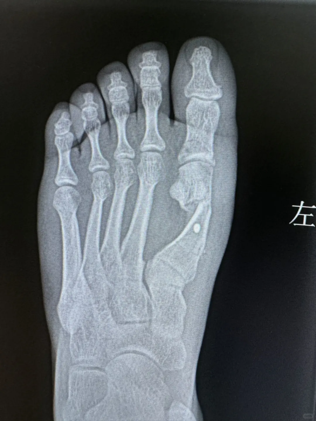 讲一组术后4周片子