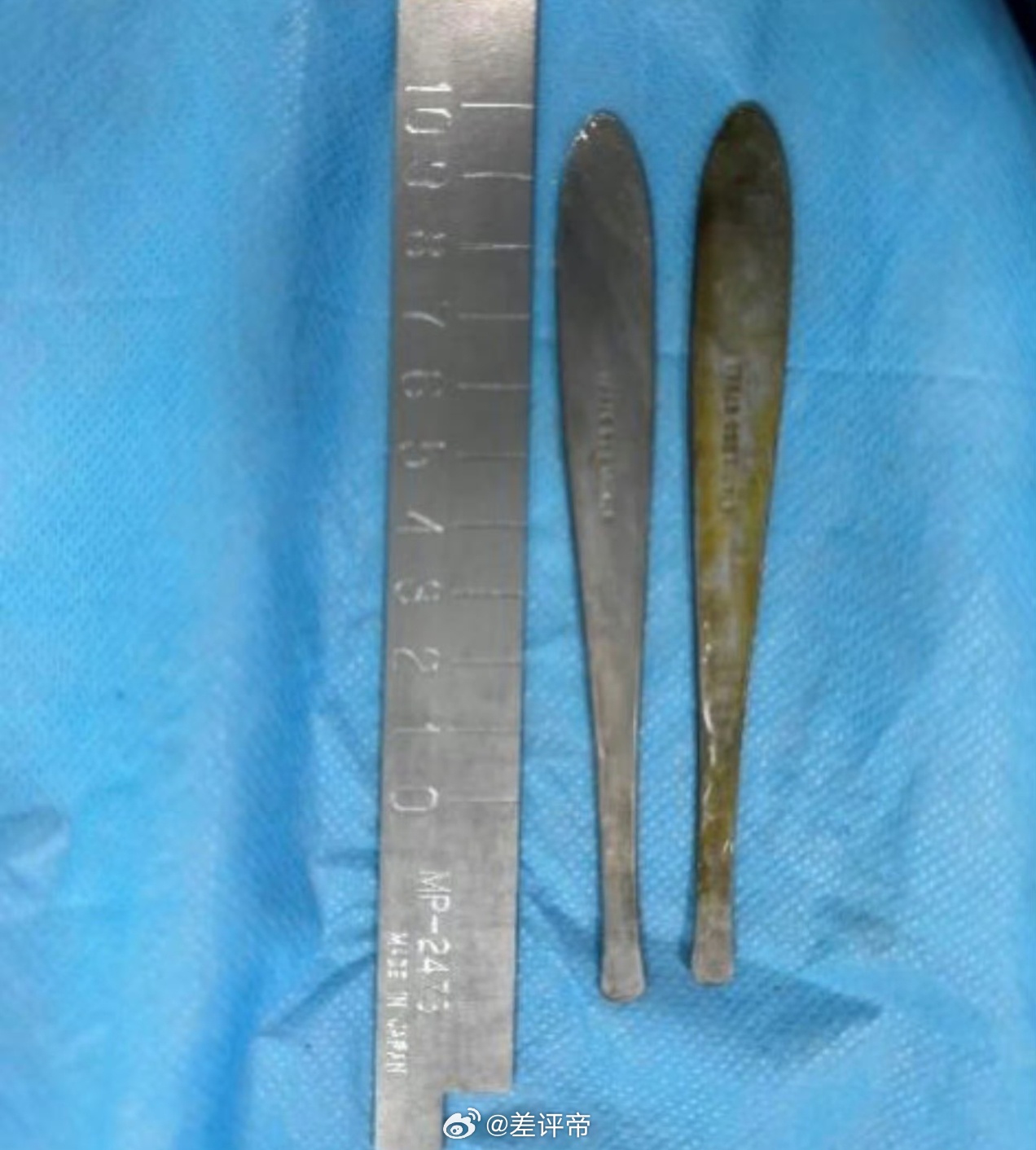 小伙腹痛CT查出肠道卡2把勺子很多人不理解是怎么毫无知觉地吞下两把勺子呢？我假如