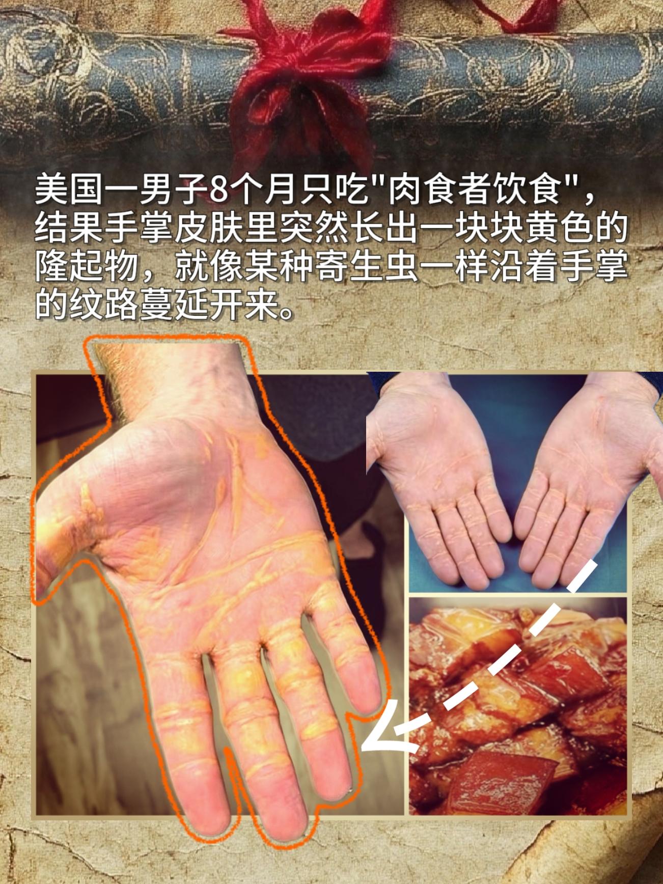 美国一男子8个月只吃"肉食者饮食",结果手掌皮肤里突然长出一块块黄色的隆起物。