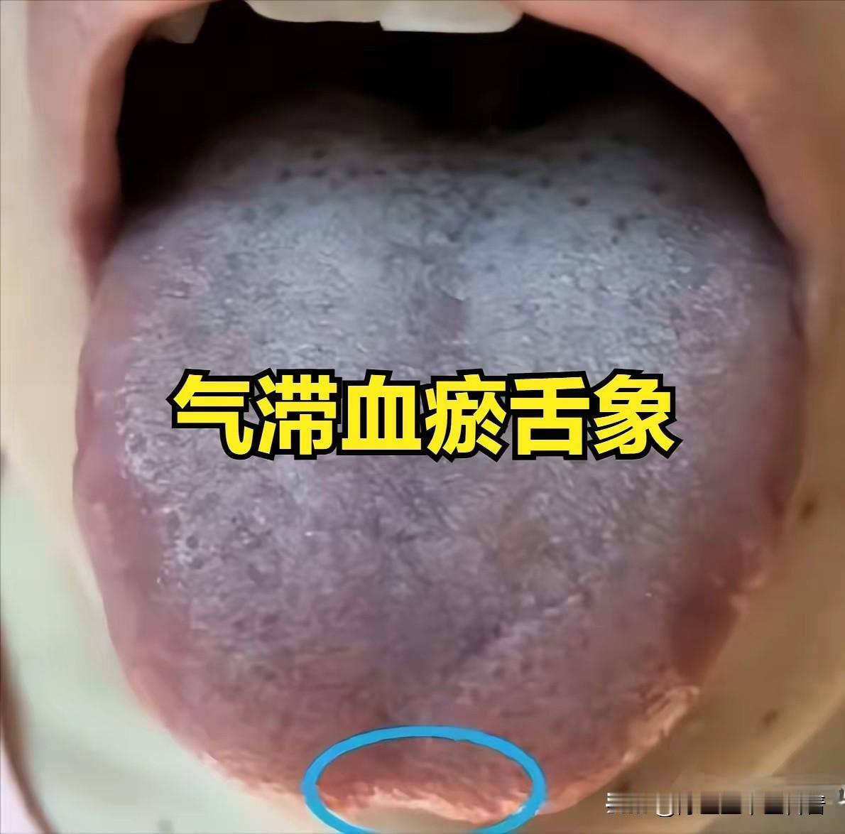 舌暗苔腻还刺痛？气滞血瘀夹湿重，两丸搭配破局
 
伸出舌头，若见舌边鼓胀、舌苔厚