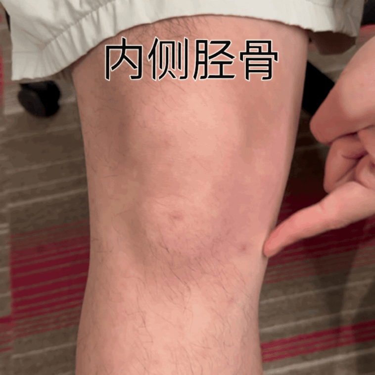 #膝关节损伤# 很多前叉友在做完手术后会经历不同位置的疼痛，你知道这些疼痛都代表