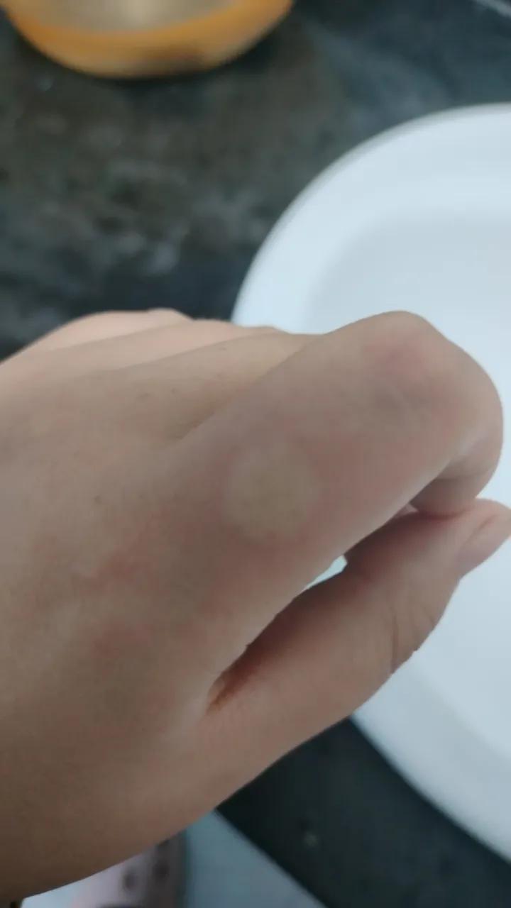 不知道怎么的，那段时间在医院照顾病人，晚上睡觉的时候被蚊子叮了一下就起了这么大的