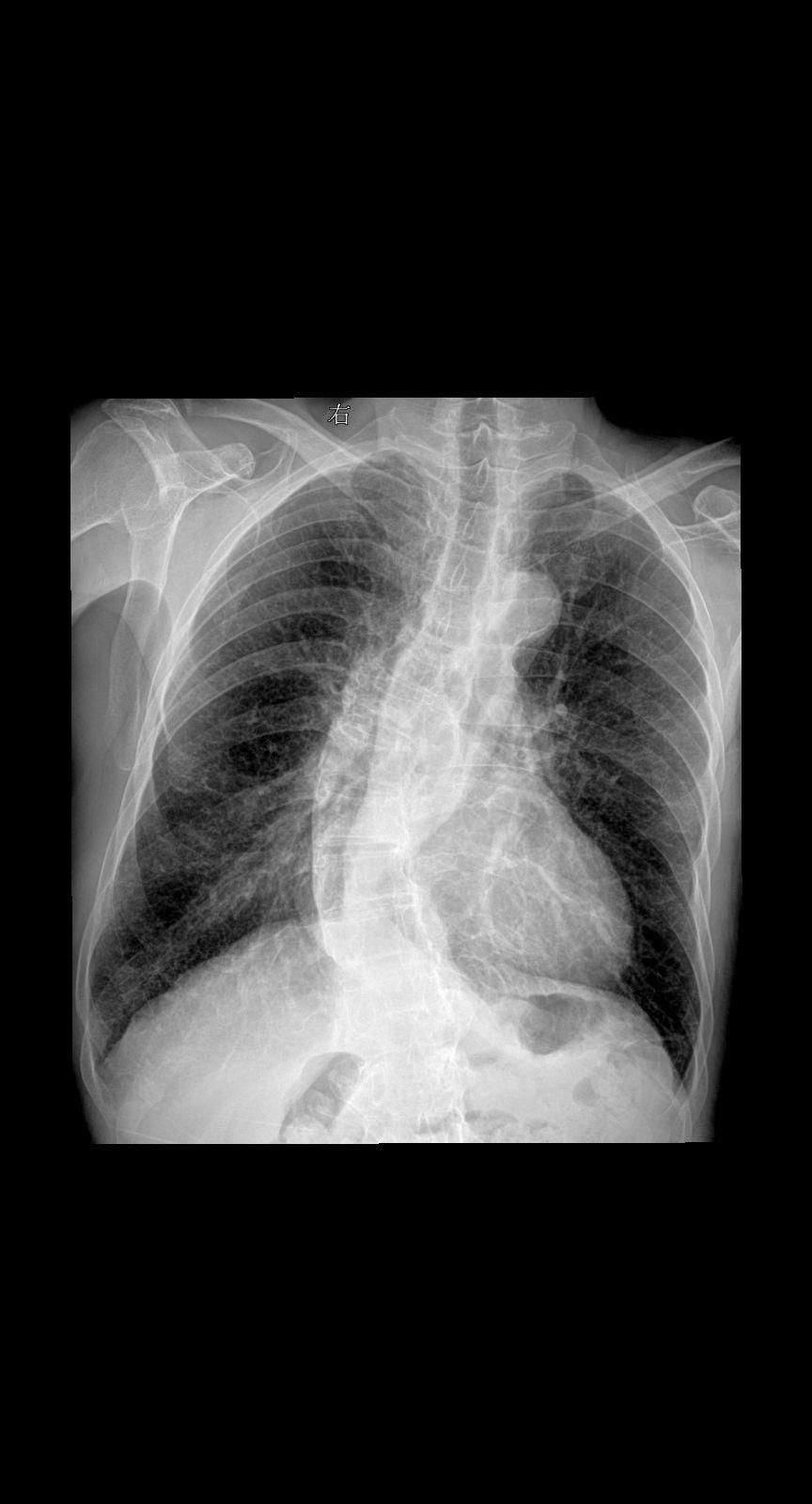 胸闷咳嗽就诊 男 80