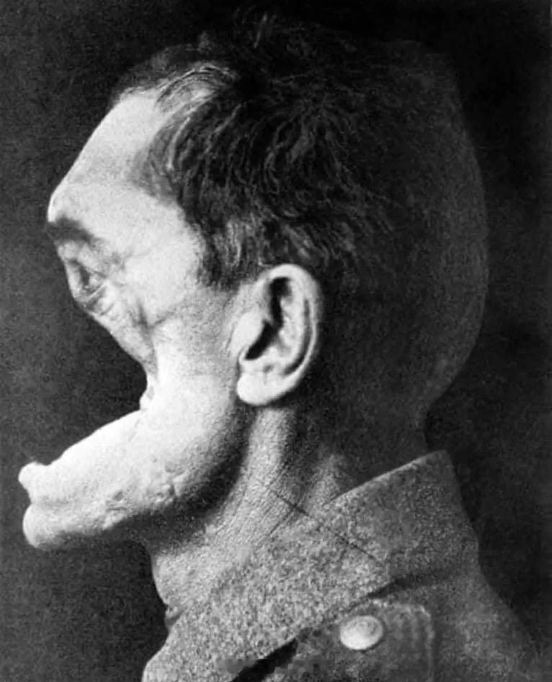 这是第一次世界大战期间一名德国士兵的照片，他的脸因炮火而严重毁容。 ​​​