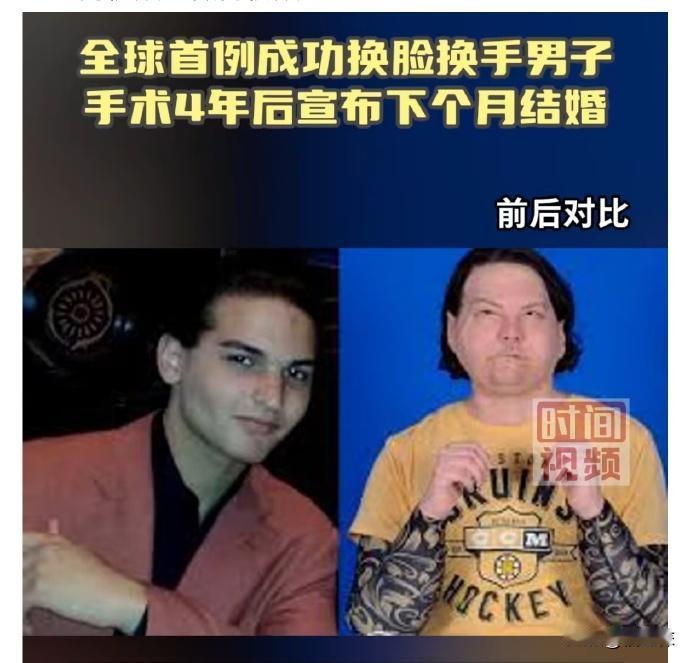 美国新泽西州，26岁男子Joe DiMeo在经历全球首例换脸换手手术后，即将步入