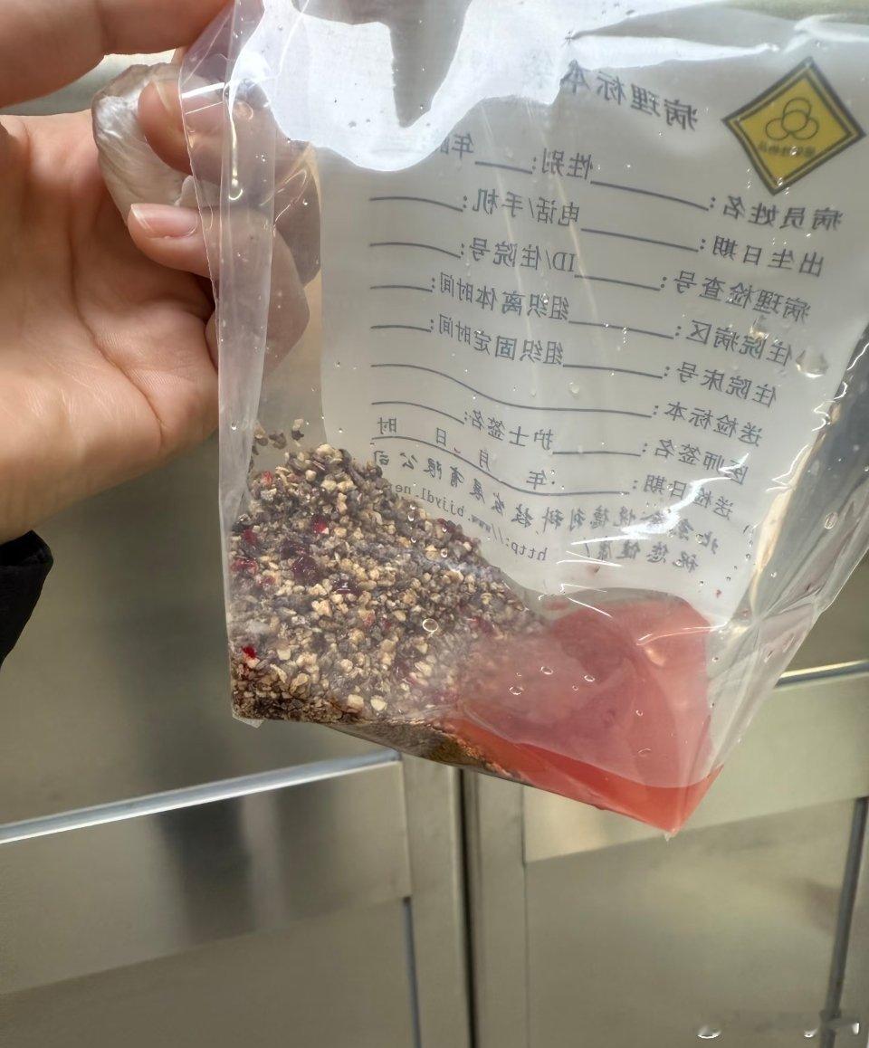 意大利小偷把肾结石误认黄金偷走肾结石长这样…这小偷是不是忘记打开盖子看看了