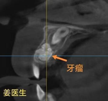 牙瘤。“牙瘤”，导致恒牙不能萌出。