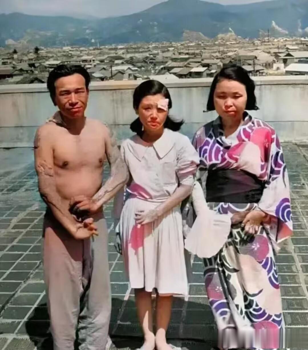 广岛原子弹爆炸中幸存的三名日本人，正在展示他们在爆炸时受的伤。
从照片中我们可以