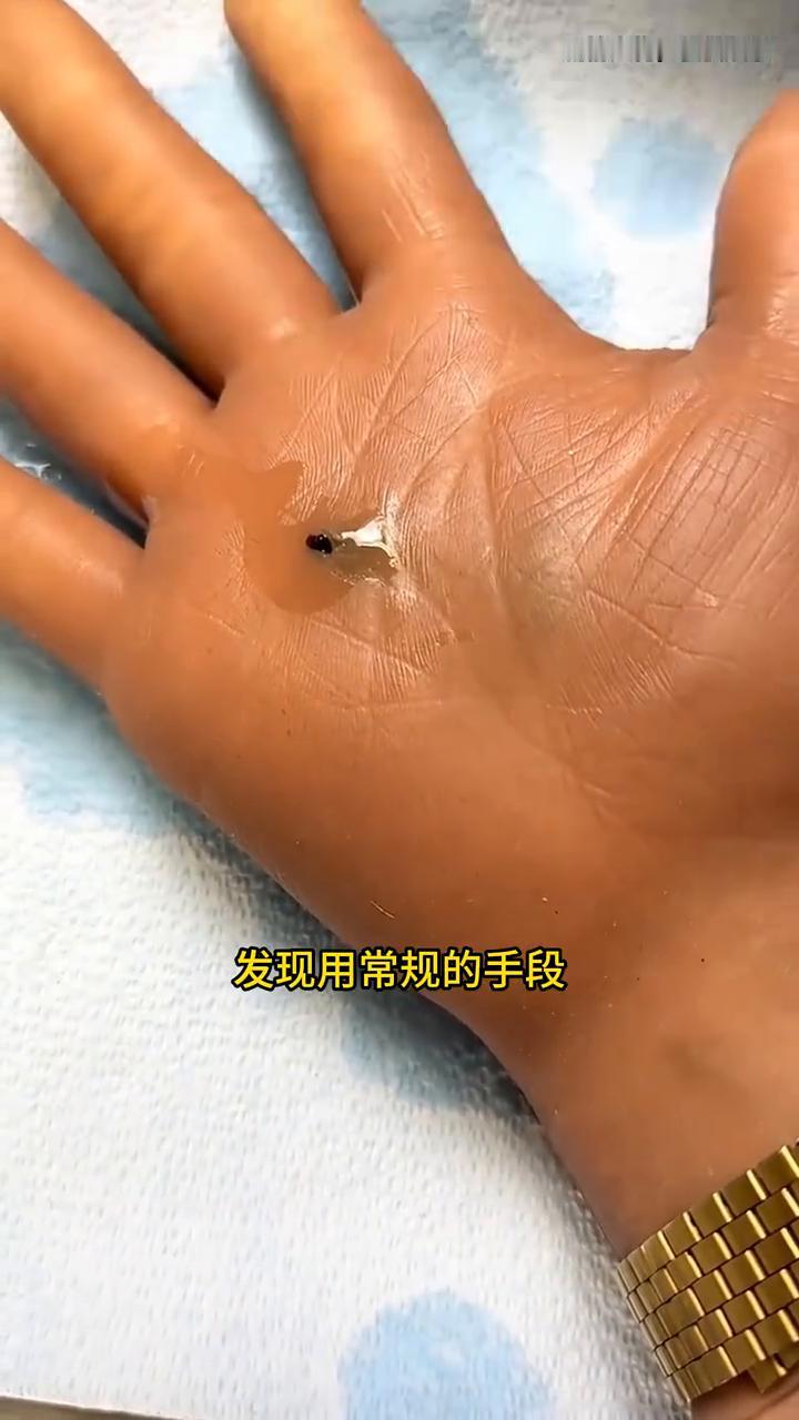 医生刚刚帮助女子在手上消了一下毒，紧接着便看到女子手掌心里面出现的黑色物体。医生