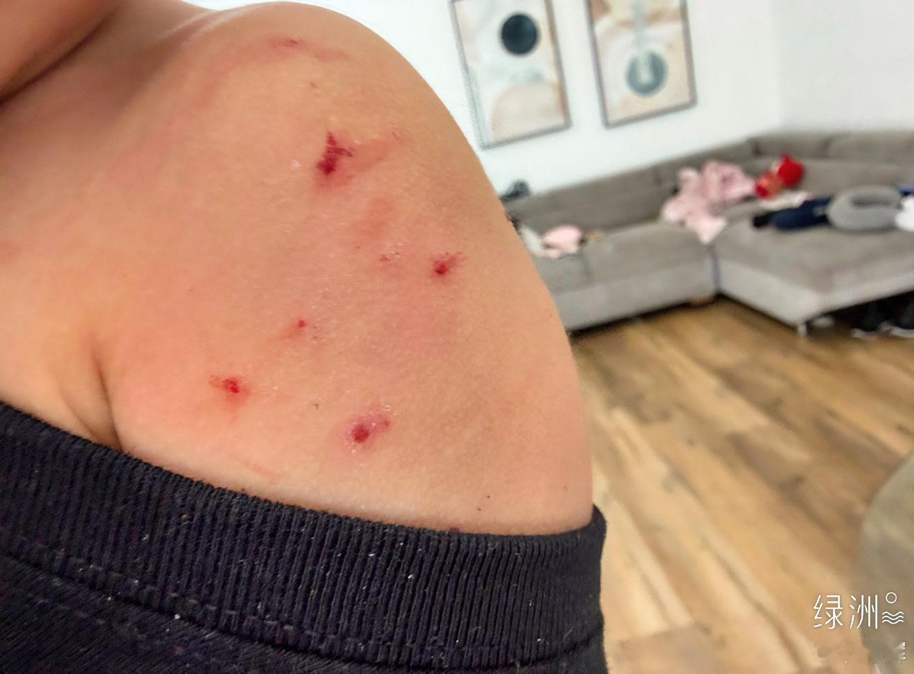 总在记忆里  （1598）：蚊子真毒，把妹妹皮肤咬了好多肿包，然后被她抓烂了。抹