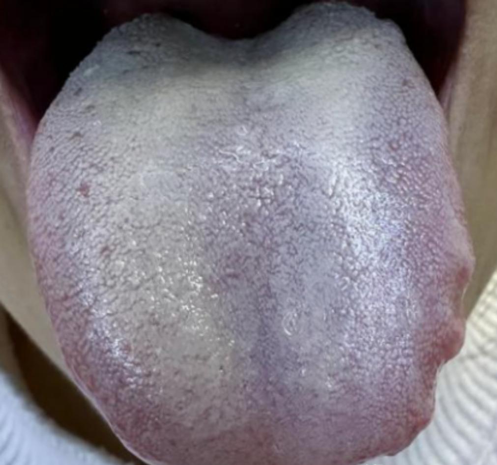 血瘀用血府逐瘀汤没用，追到源头其实是痰湿太重！
看这个患者，主诉：身上总是莫名出