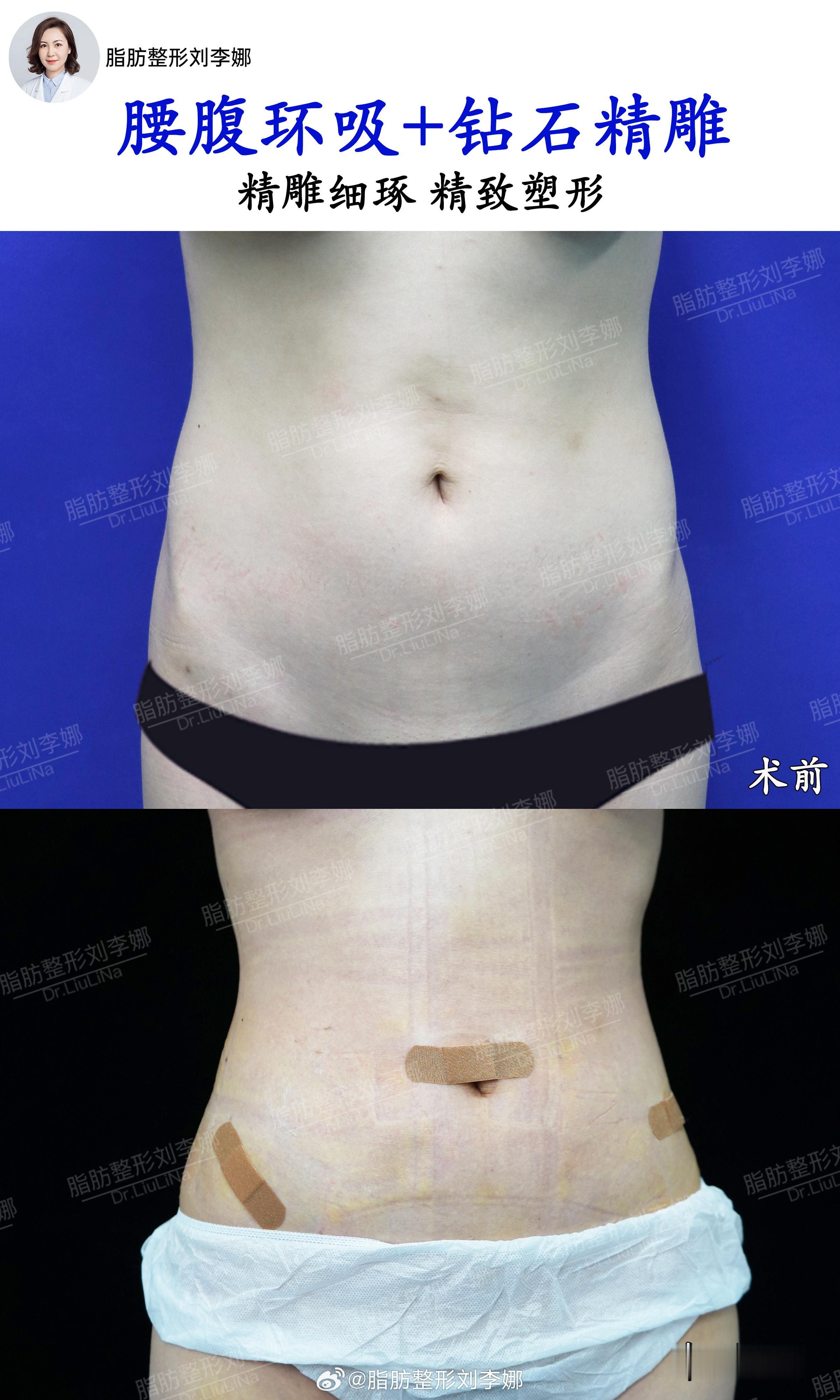 脂肪整形刘李娜腰腹吸脂腰腹抽脂 术前腰腹皮下脂肪堆积，腰线不够明显，有些偏H型腰
