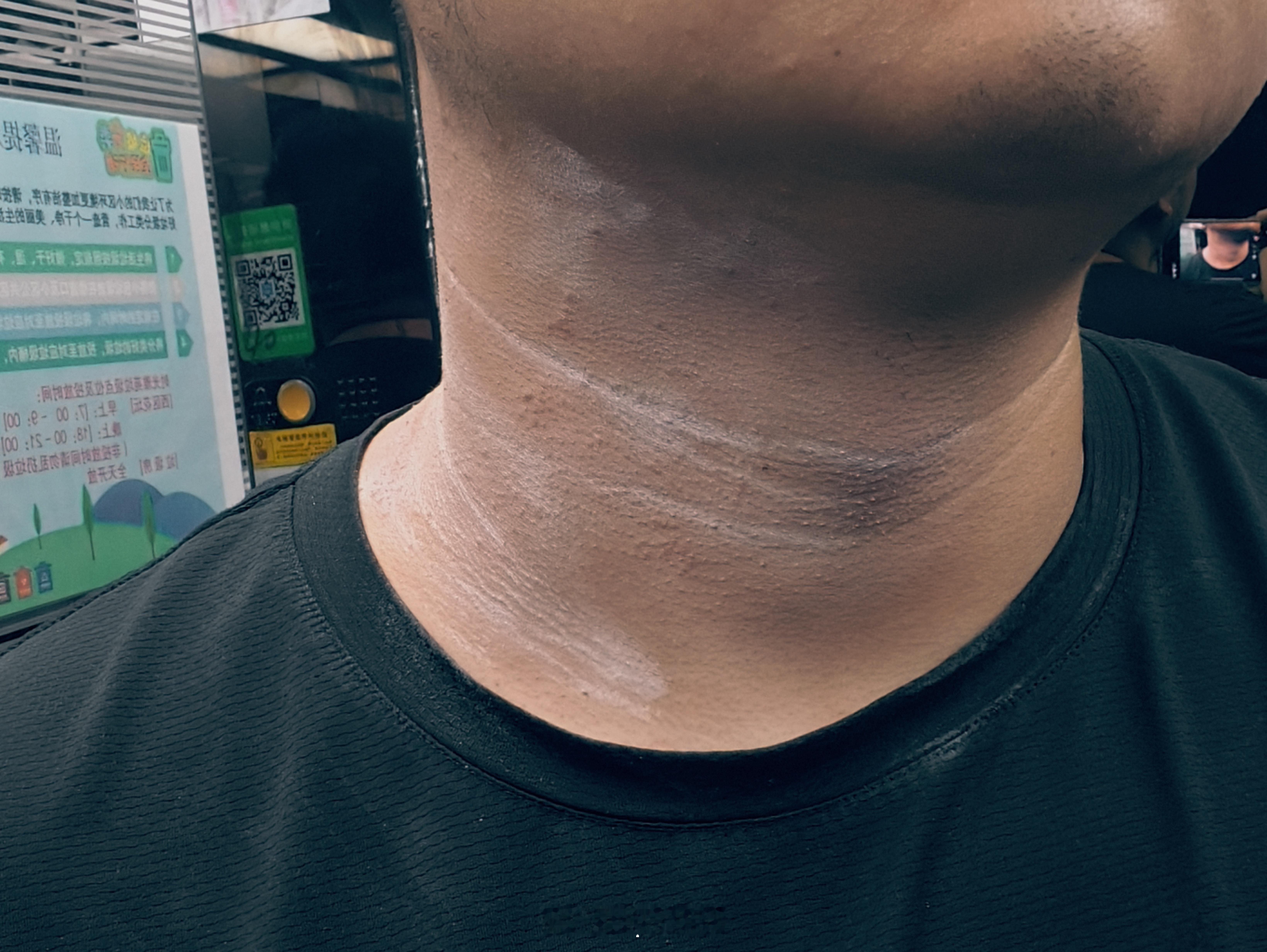 不知道是住入酒店床单不干净还是衣服闷着不透气，这几天脖子这边起疹子，导致训练不得