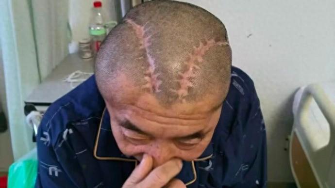 男子右脑出血被开左脑，医生发现出错又开右脑，家属提出赔300万被拒！妻子：“我老