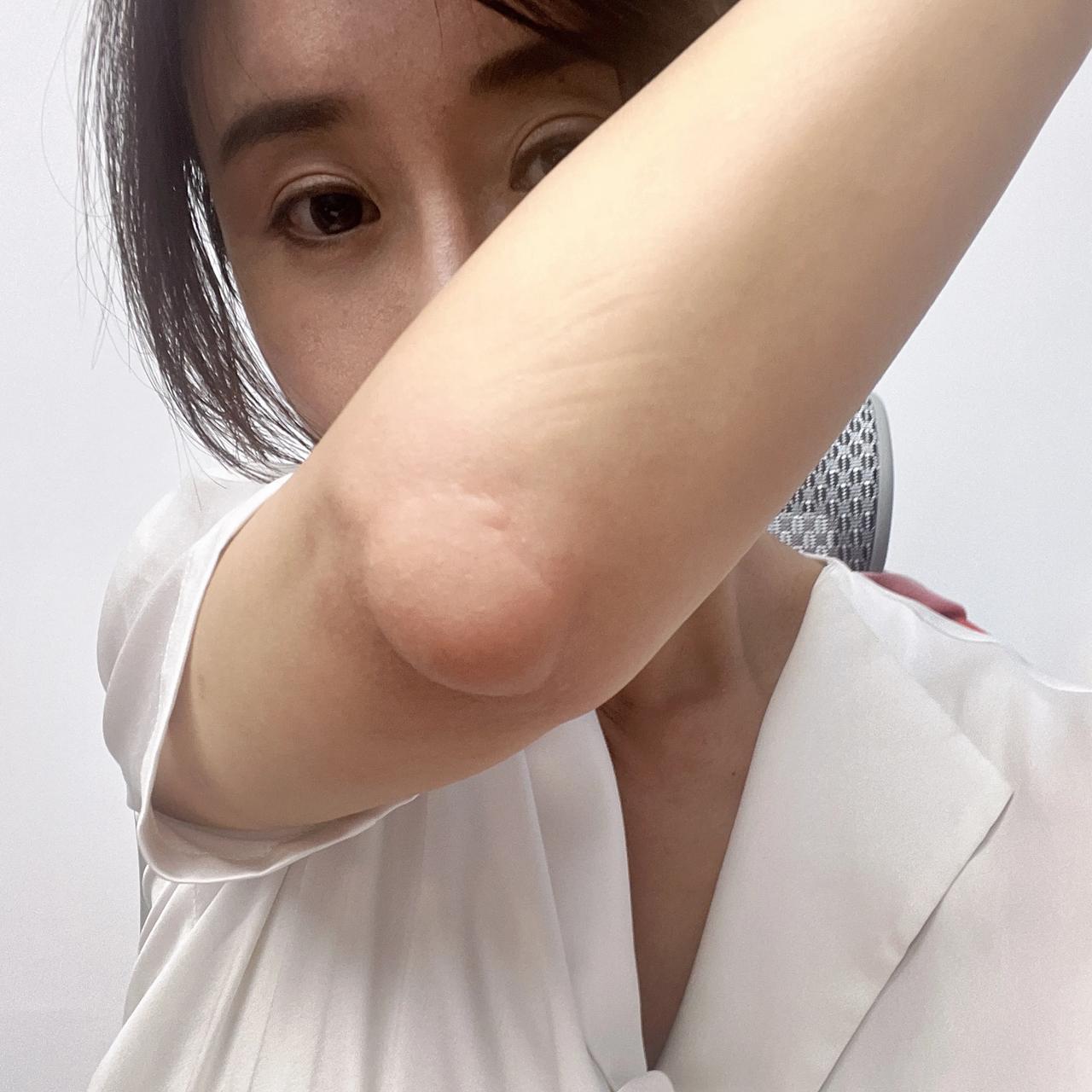 看看超大号蚊子包的形态以及形成机制～～