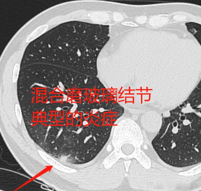 【定期随访观察！？肺结节会在下次复查前，突然长大变成癌吗？】#守护呼吸健康# 体