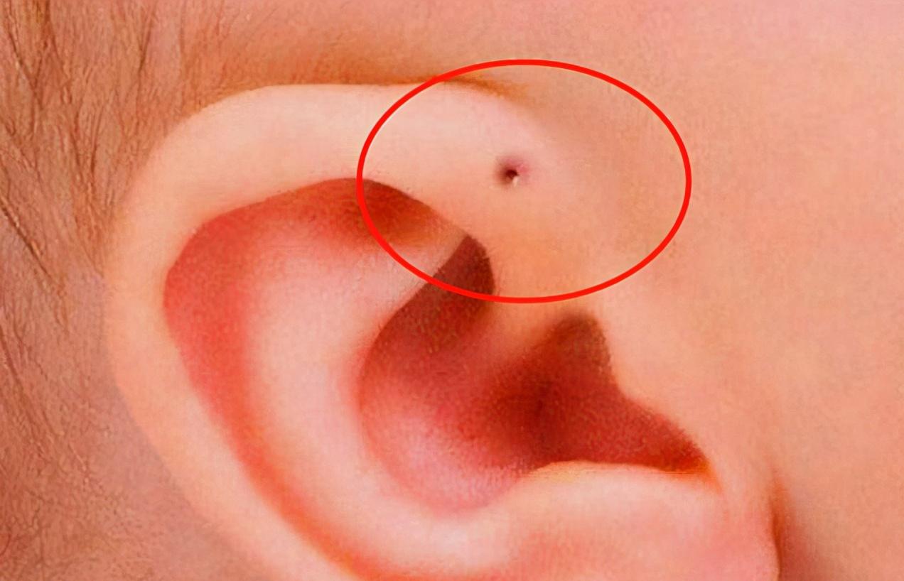 耳朵上的“小孔”不是痘痘！是颗定时炸弹！

看到一则新闻六岁孩子因为耳朵那个小孔