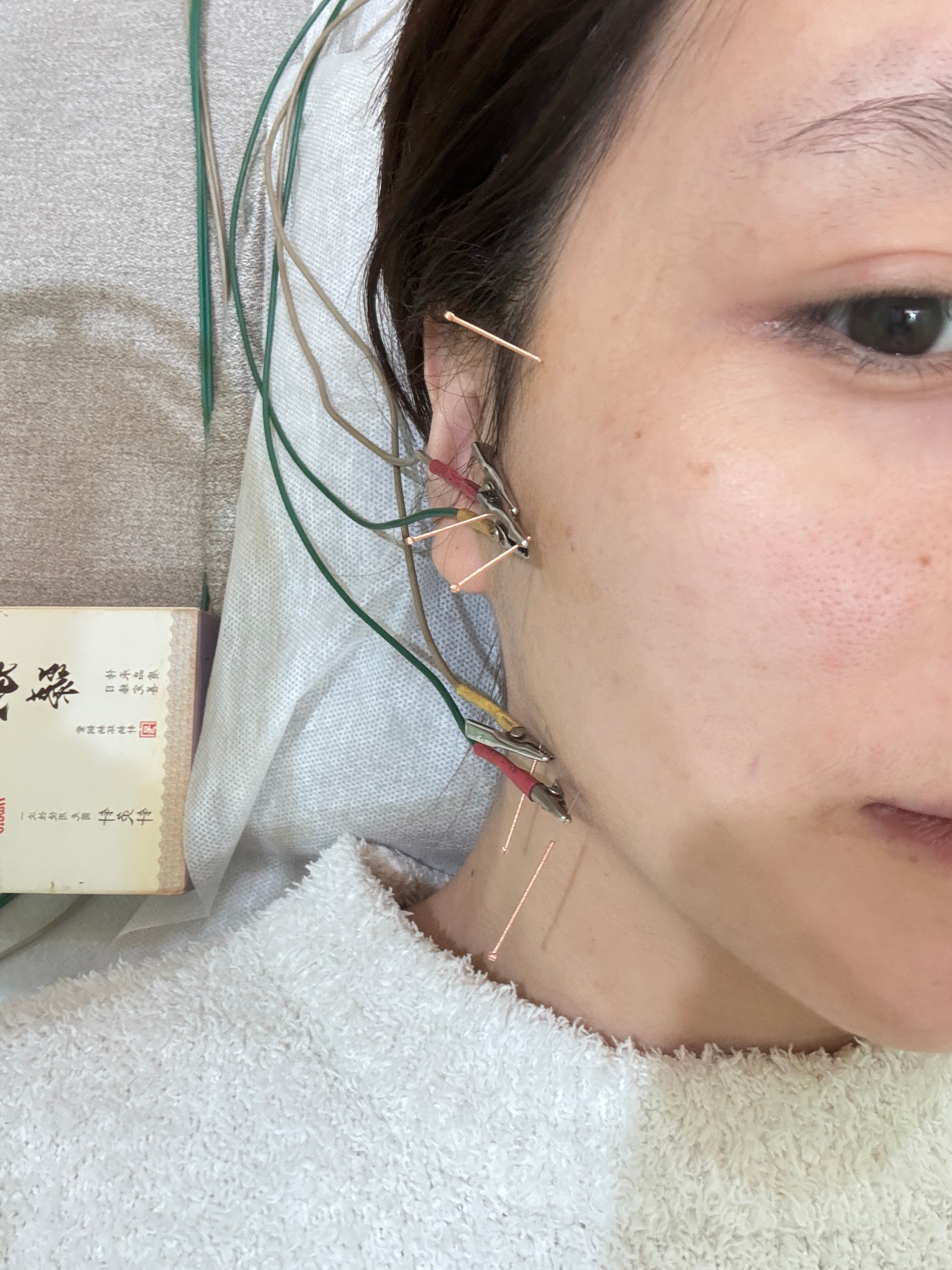 真的是活久见 咬肌痉挛是什么原因前两天发现咀嚼的时候脸颊耳根连接处特别痛 像有根