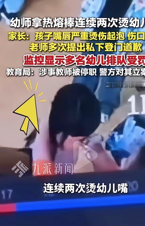 光一句道歉就想翻篇？

面对被热熔棒烫伤嘴唇的5岁孩子，

这位父亲坚决不肯和解