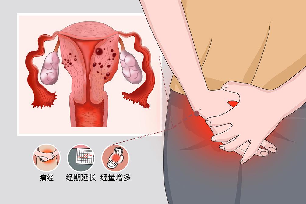 #健康真探社#【经期痛经、量多，小心子宫腺肌病！】作为女性，每个月总会经历几天特