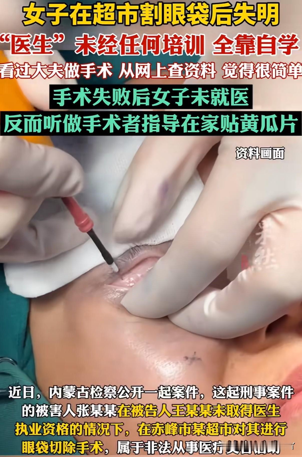 胆真大！！！女子超市割眼袋“医生”却是一本医书没看过全靠自学的人才，最后导致左眼