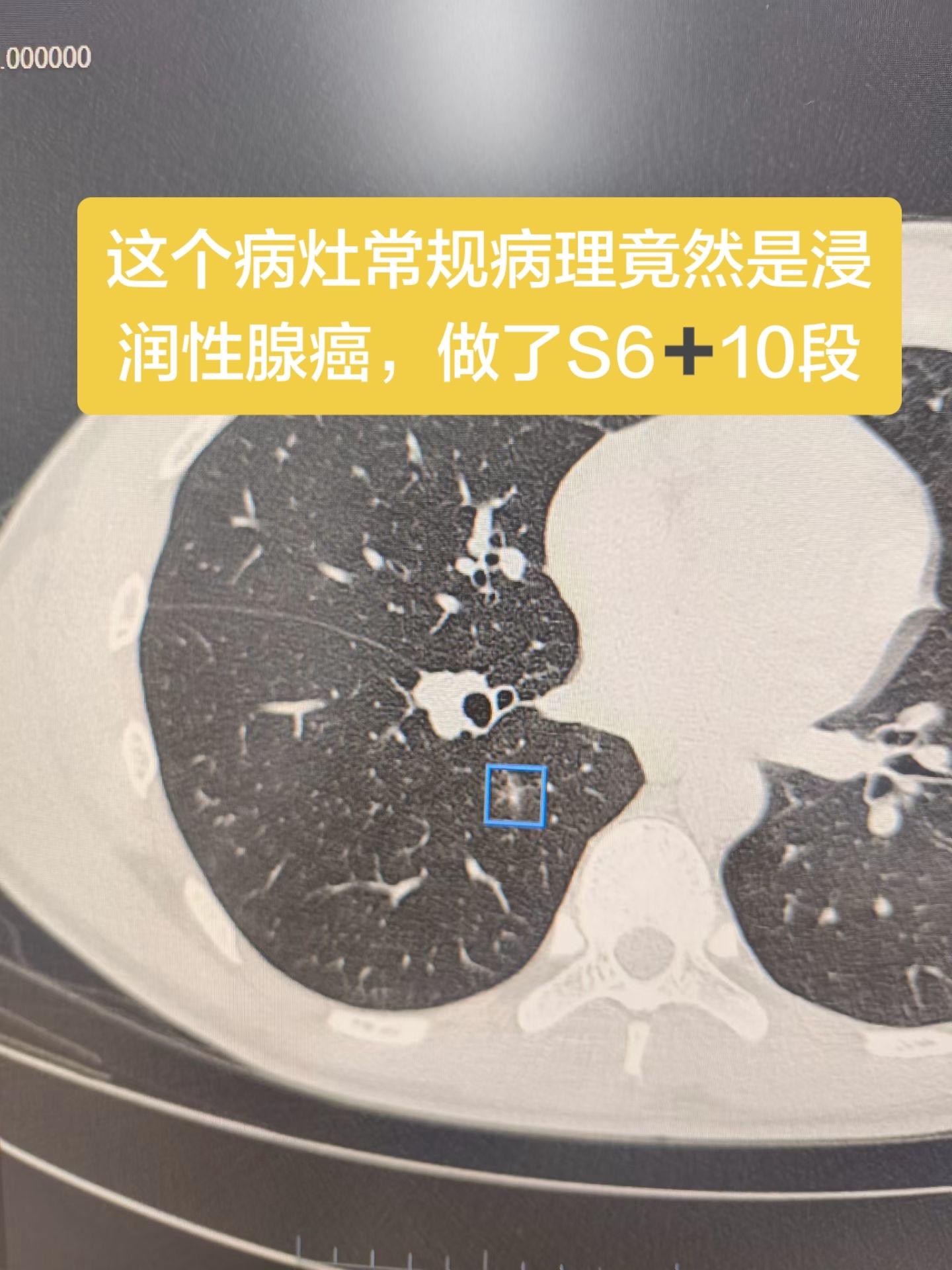 这个病灶常规病理竟然是浸润性腺癌，做了S6➕10段……