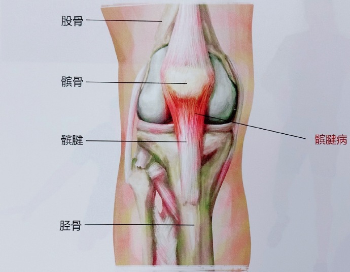 100个损伤康复说明书 【髌腱炎】今天我们来聊聊这个困扰很多运动爱好者的损伤，也