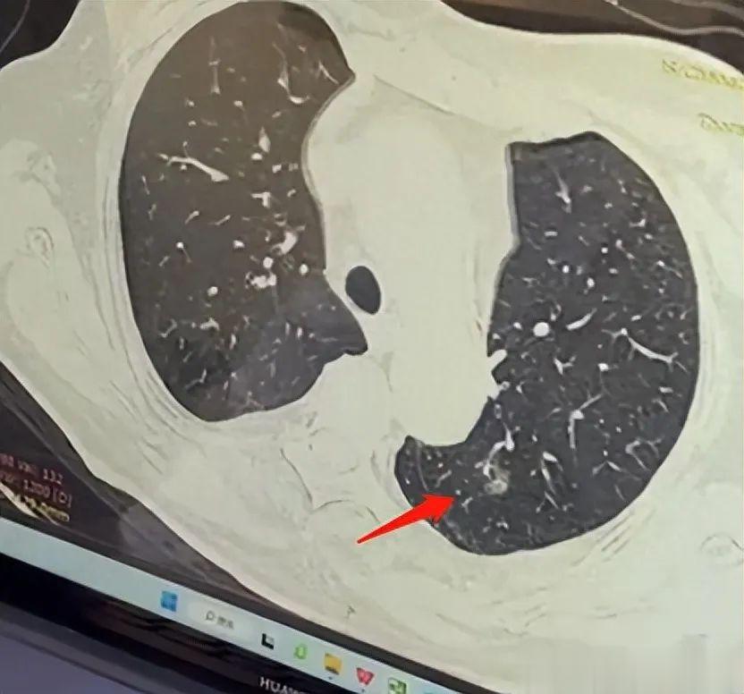 “考虑炎症”的肺磨玻璃结节，就可以不用管了吗？要听医生劝！一位85岁的老人，去年