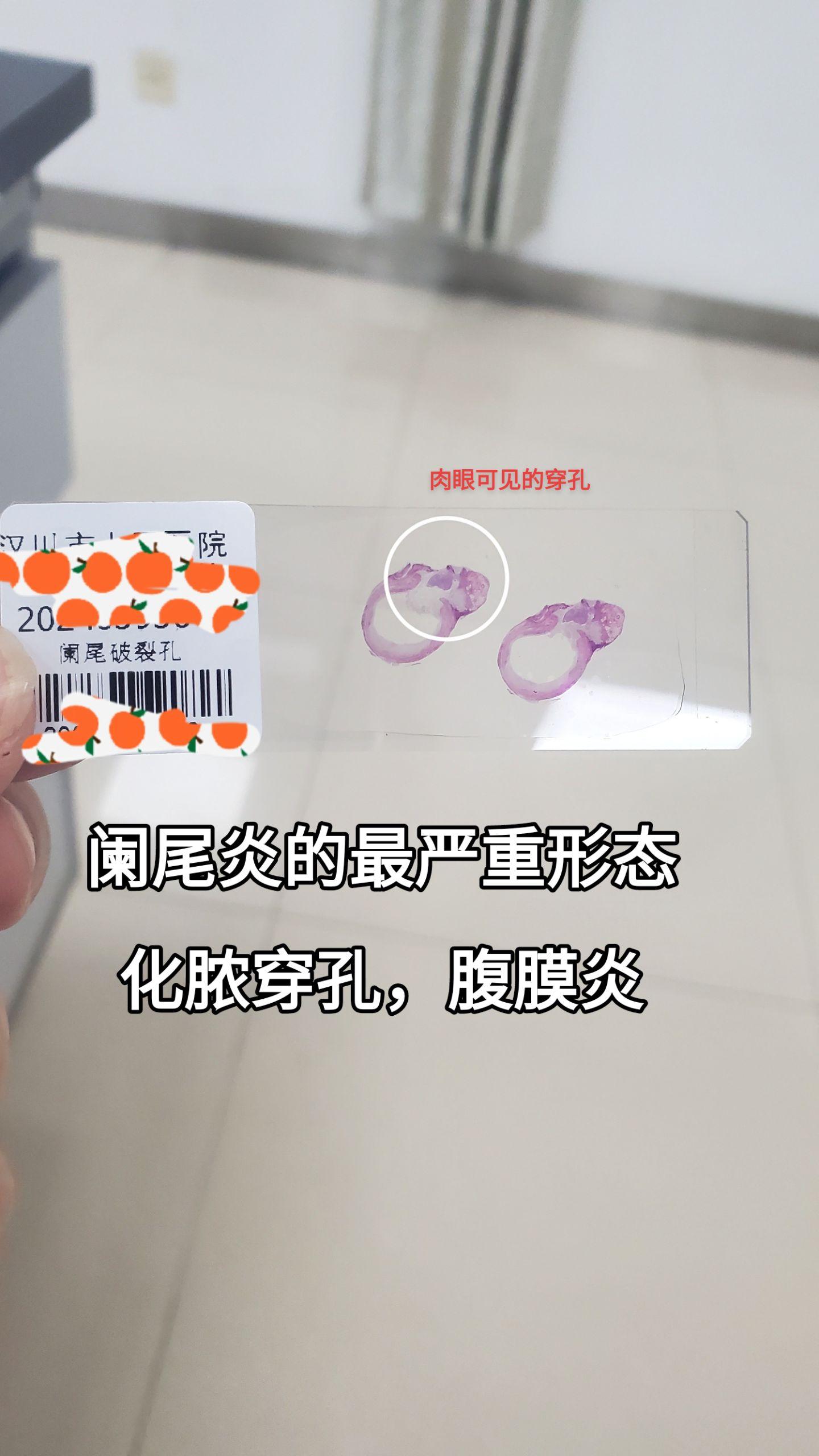 阑尾炎穿孔