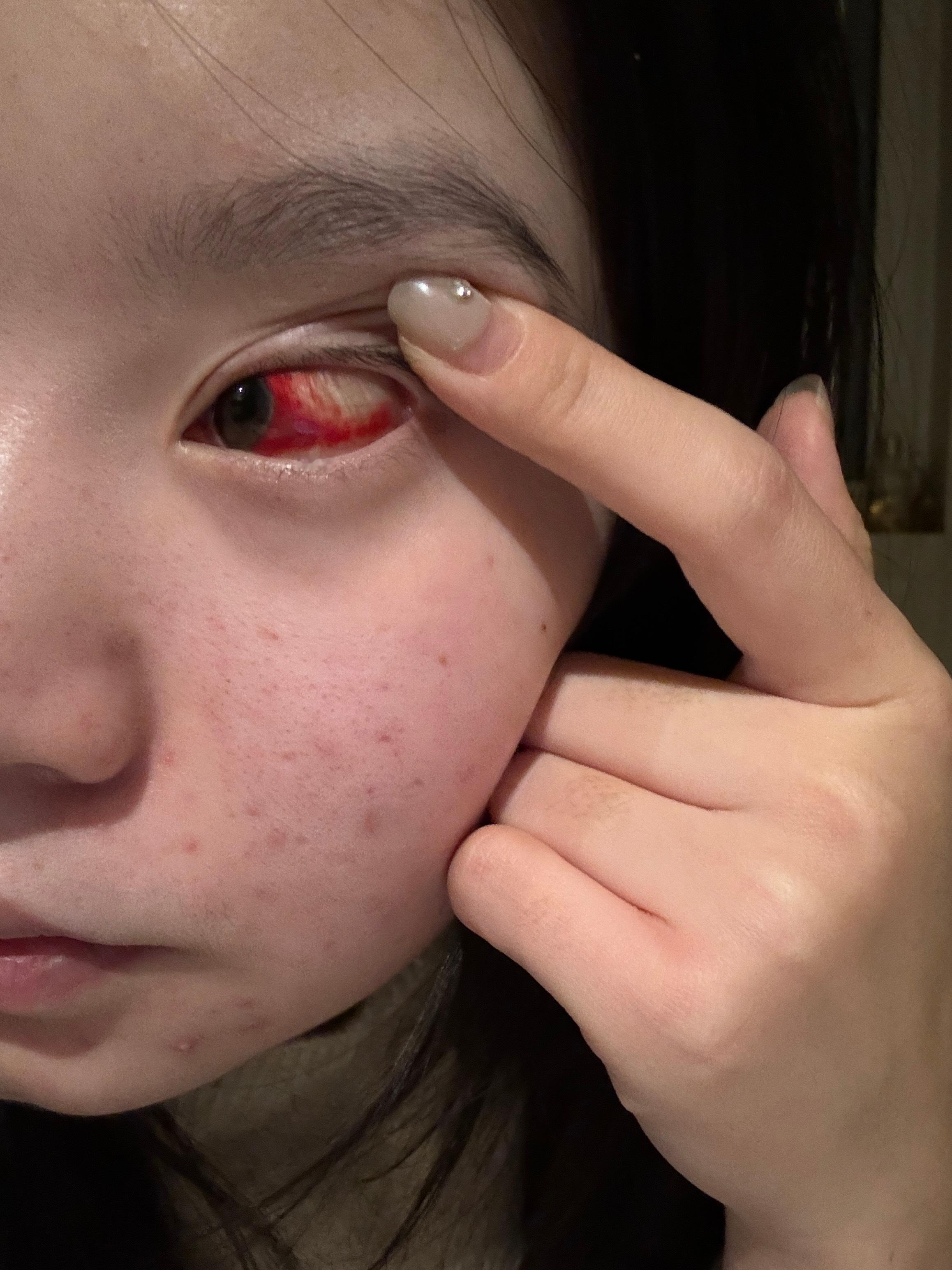 这一个月都没更新的原因是大年初一，一觉睡醒眼睛就成这样了，到现在还没好。今天又突