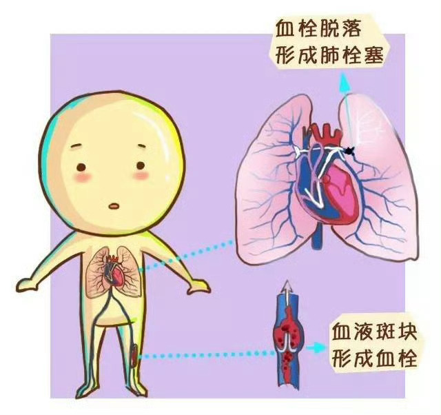 女大学生坐硬座31小时返校心脏骤停其实不光是飞机经济舱，像火车、客车，甚至电脑桌