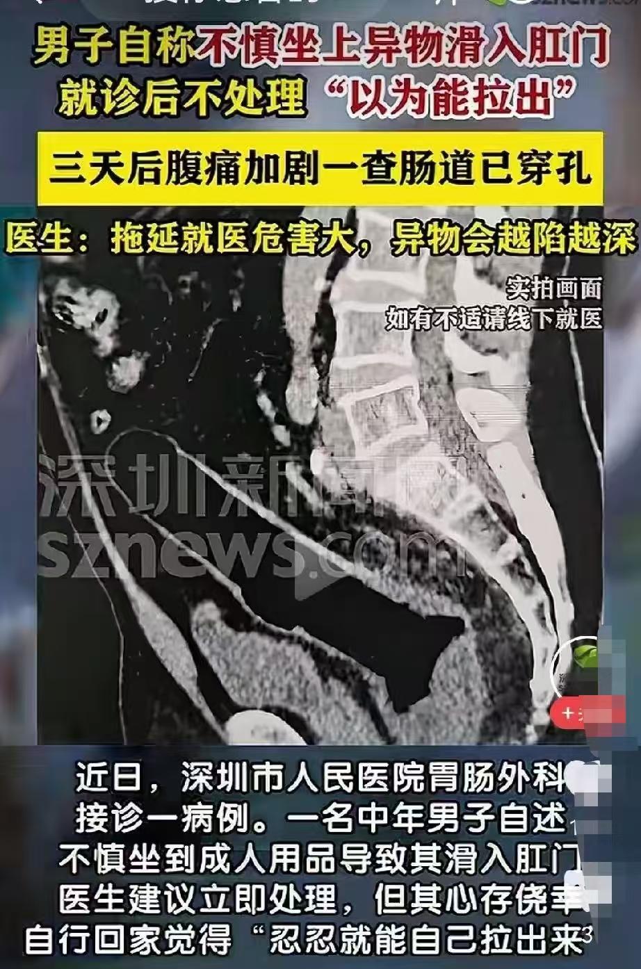 广东深圳，一男子不慎坐在了成人用品上，正好怼进了肛门里，男子赶紧去医院就诊，医生