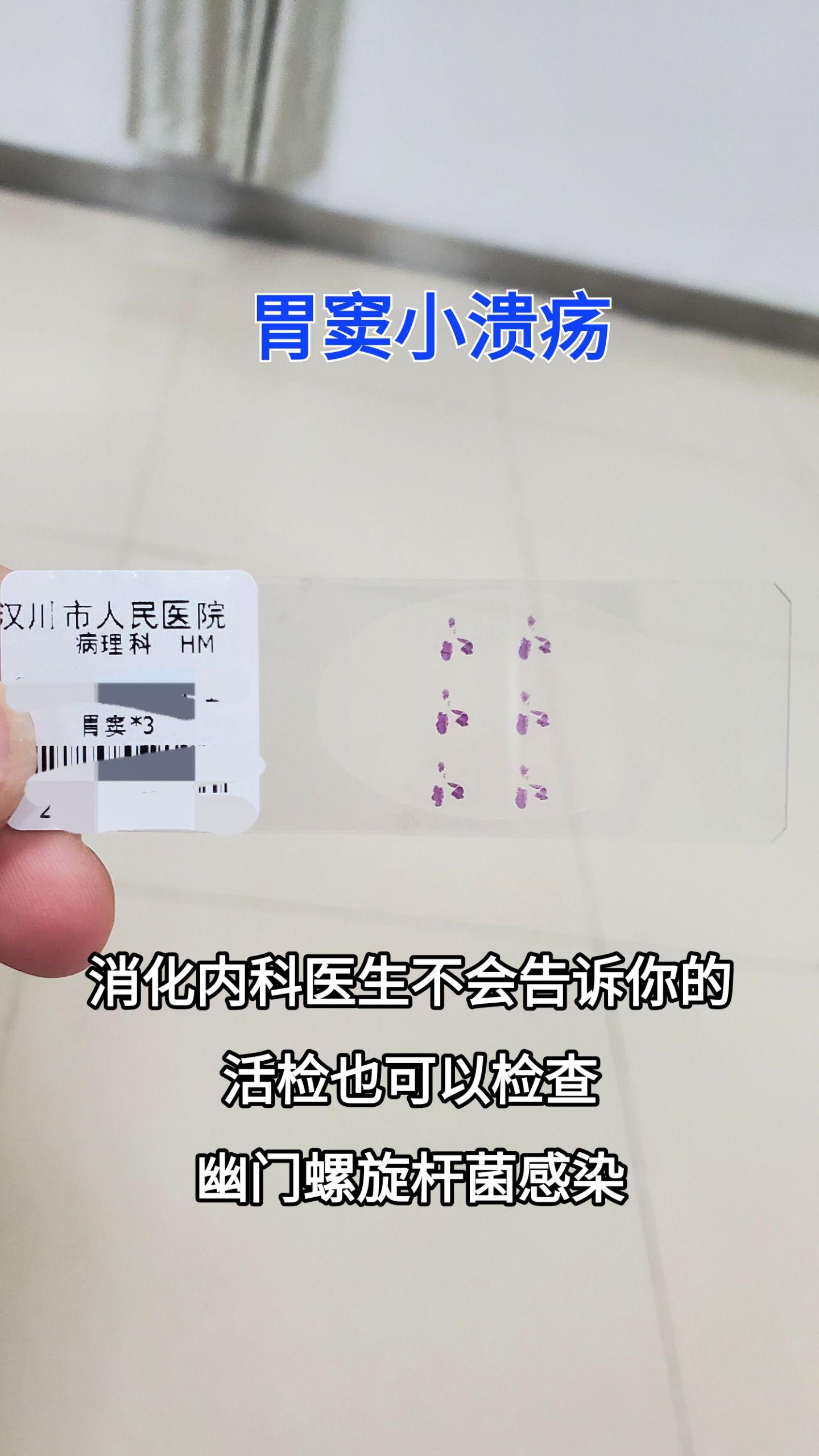 胃溃疡
幽门螺旋杆菌