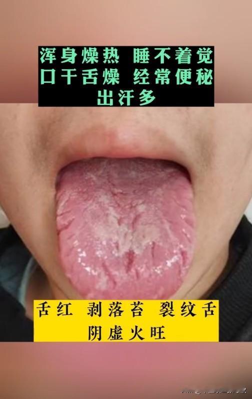 门诊患者络绎不绝，今天分享最典型的6张舌像
涵盖80%的患者人群，大家可以对症自