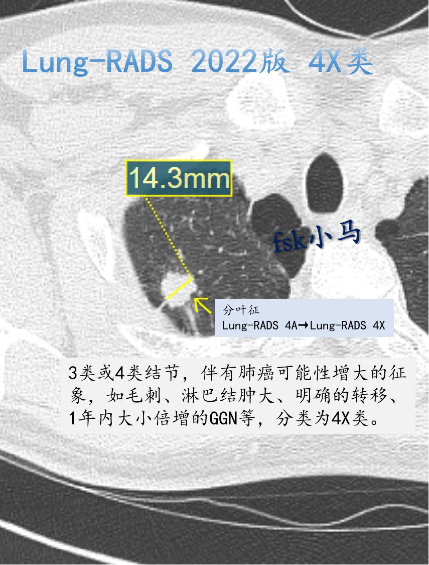 Lung-RADS 2022版 4X类：人群罹患率约＜1%。3类或4类...