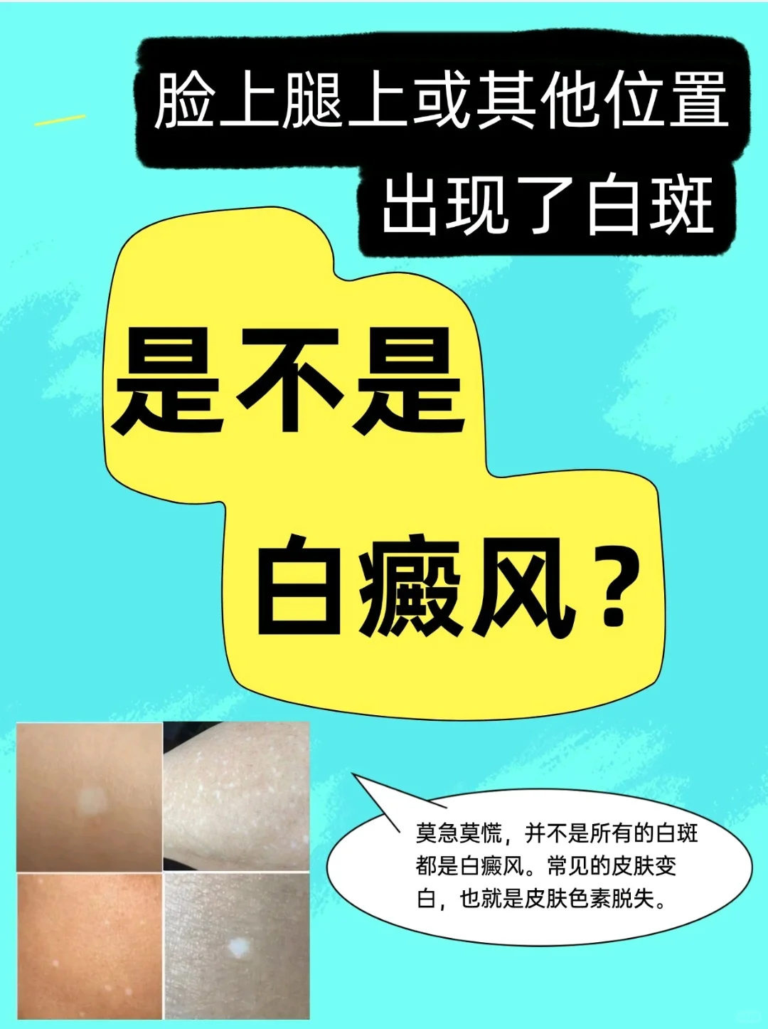 身上出现白斑怎么回事❓被误认为是白癜风