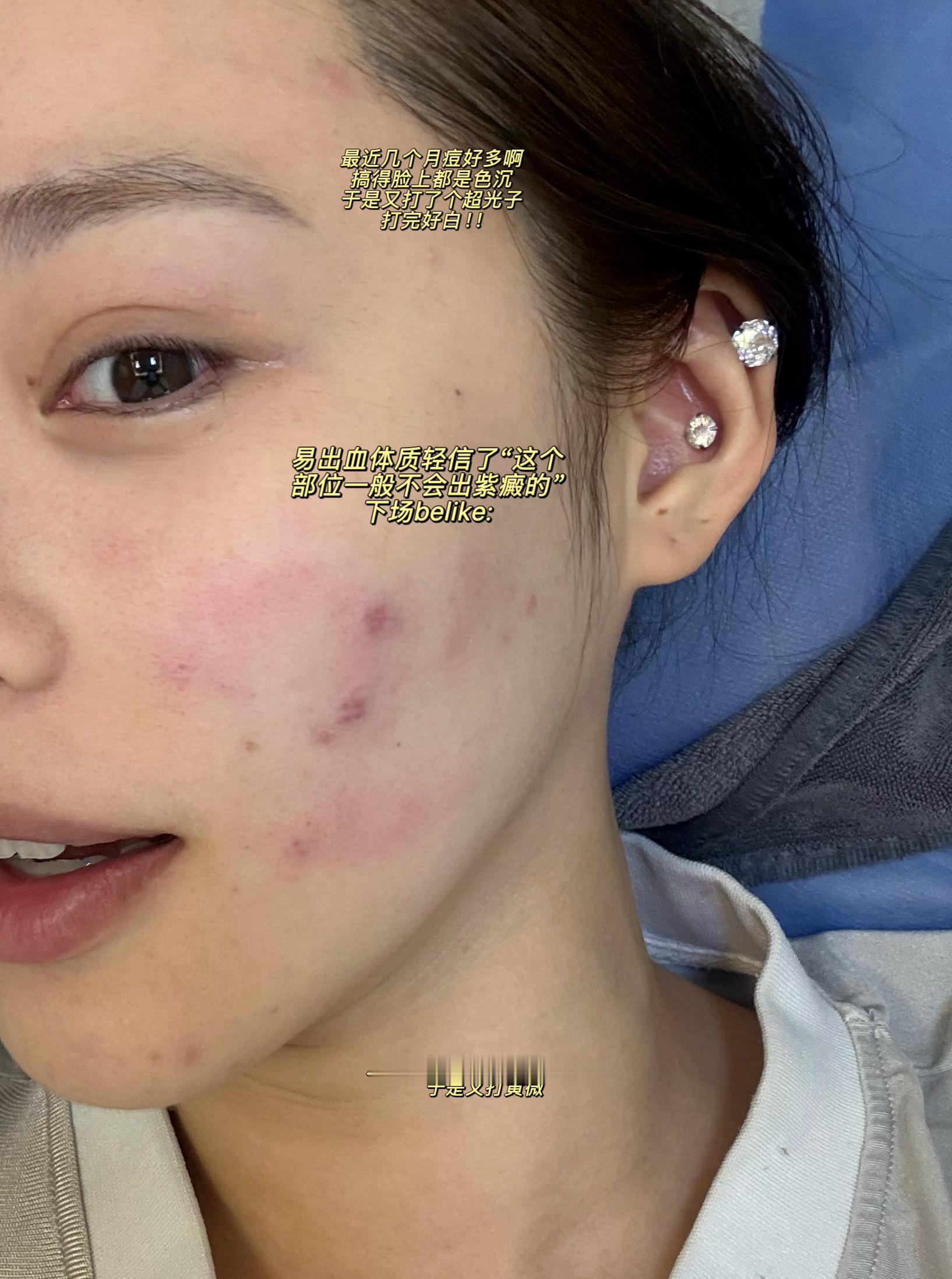 超光子打完打染料激光，然后又打英伦大提升，然后又打面颈黄金微针！！最近多少是有点