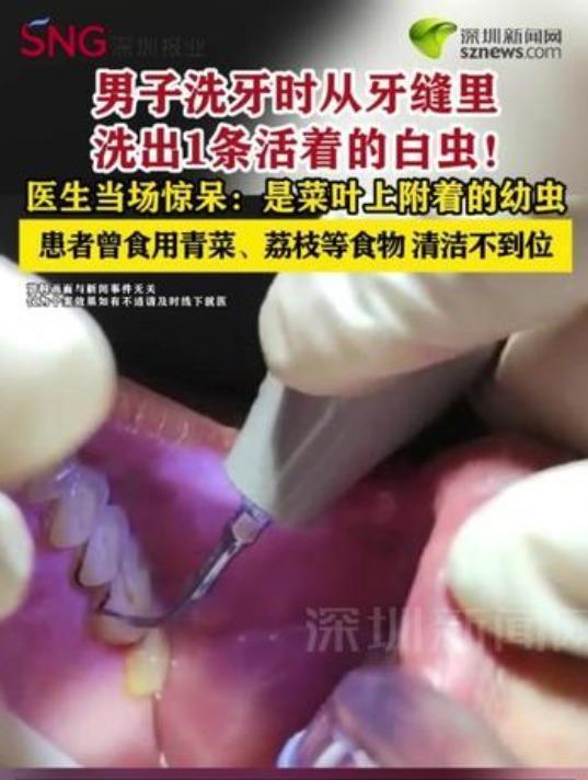 “头皮发麻！”7月9日报道，福建泉州，一男子不太注意口腔卫生，他假牙戴着很不舒服