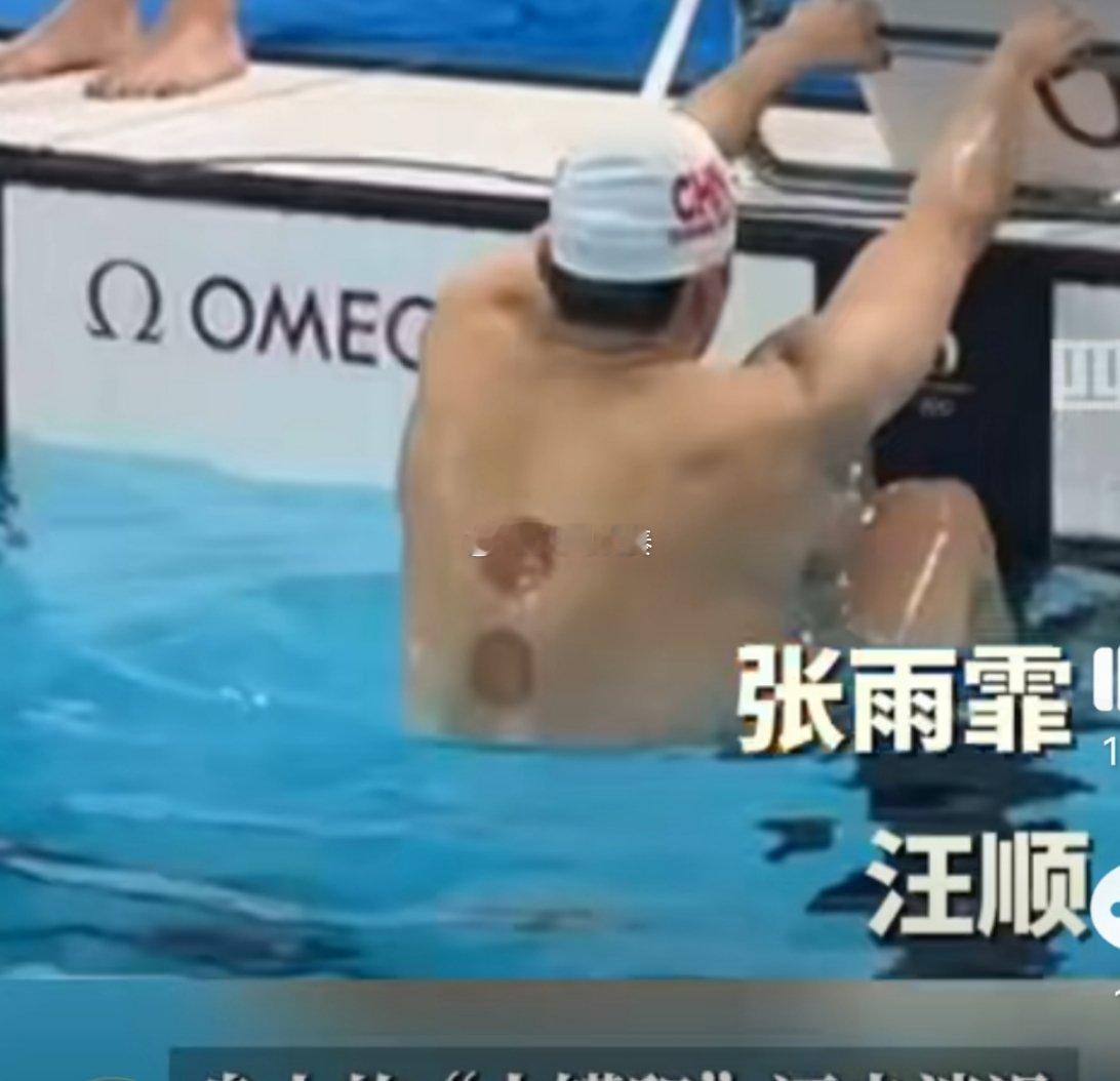 #中国游泳队身上全是火罐印#中医里面两个疗效最直接的项目：针灸和拔罐，其实算是中