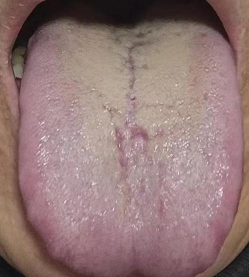 一看这种舌象，就是平时不知节制，严重损伤脾肾两脏了
 
患者主诉：房事不给力，不