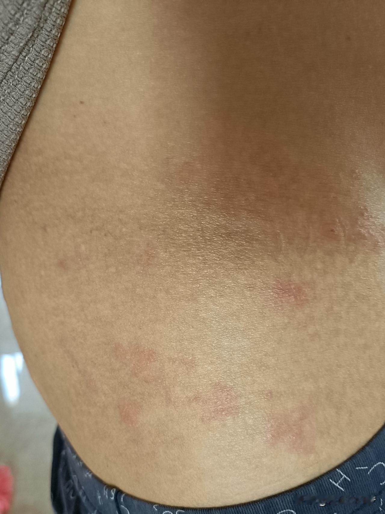 宾馆住了一晚，被什么咬了。[捂脸]


被虫子咬了之后 这是什么虫子咬的 被🐝